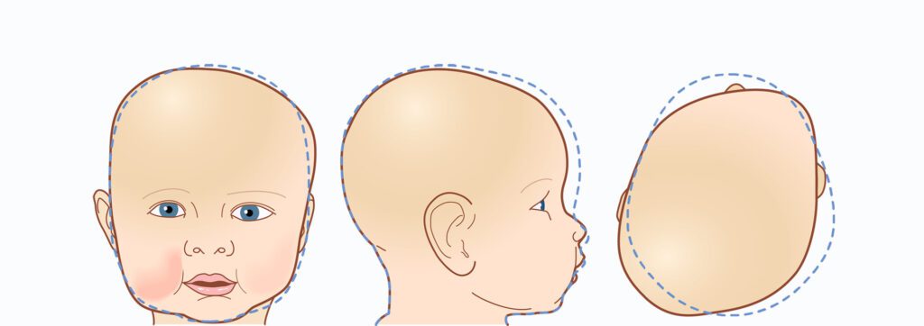 Cranial Helmet for kids