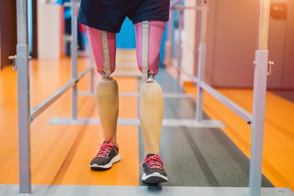 Above Knee Prosthetics Chattanooga TN